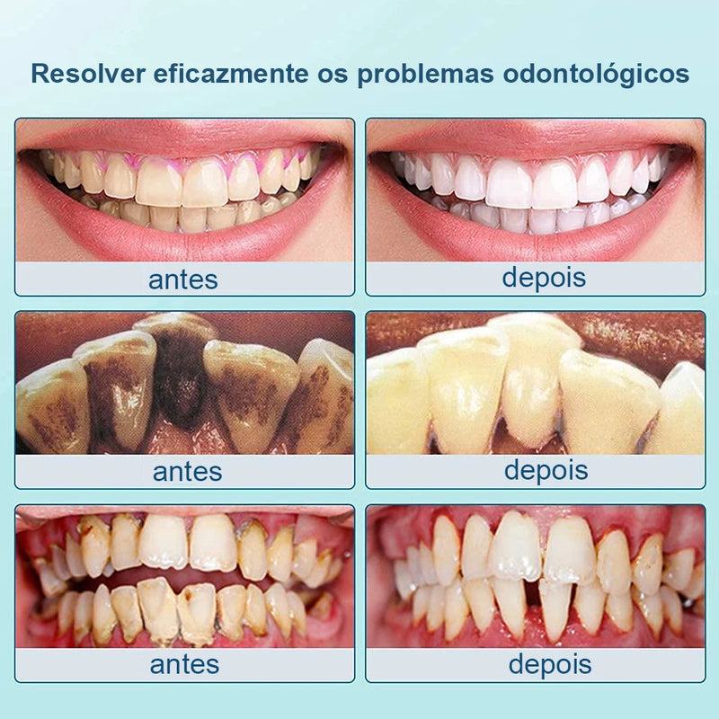 Limpador De Dentes Elétrico Ultrassônico